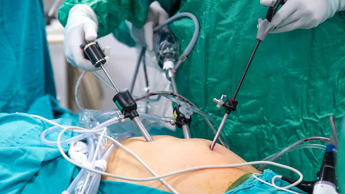 Bariatric Surgery for Diabetes